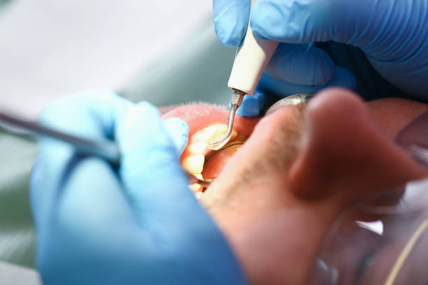 Best Emergency Dental Extractions in Napa, CA
